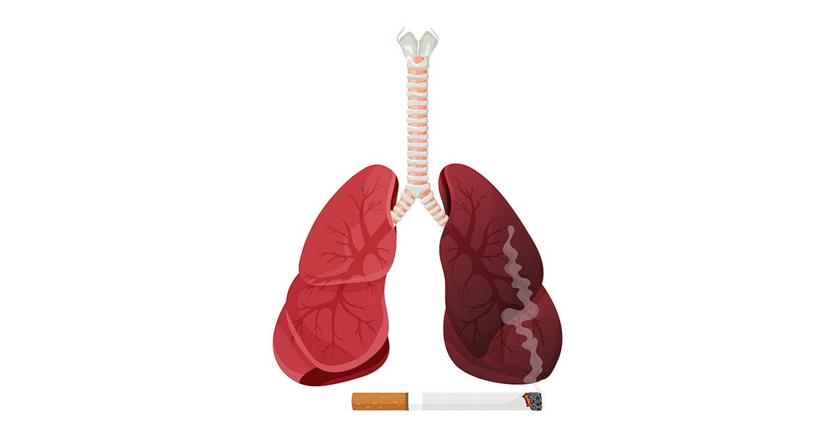 Impact of Smoking on Lungs