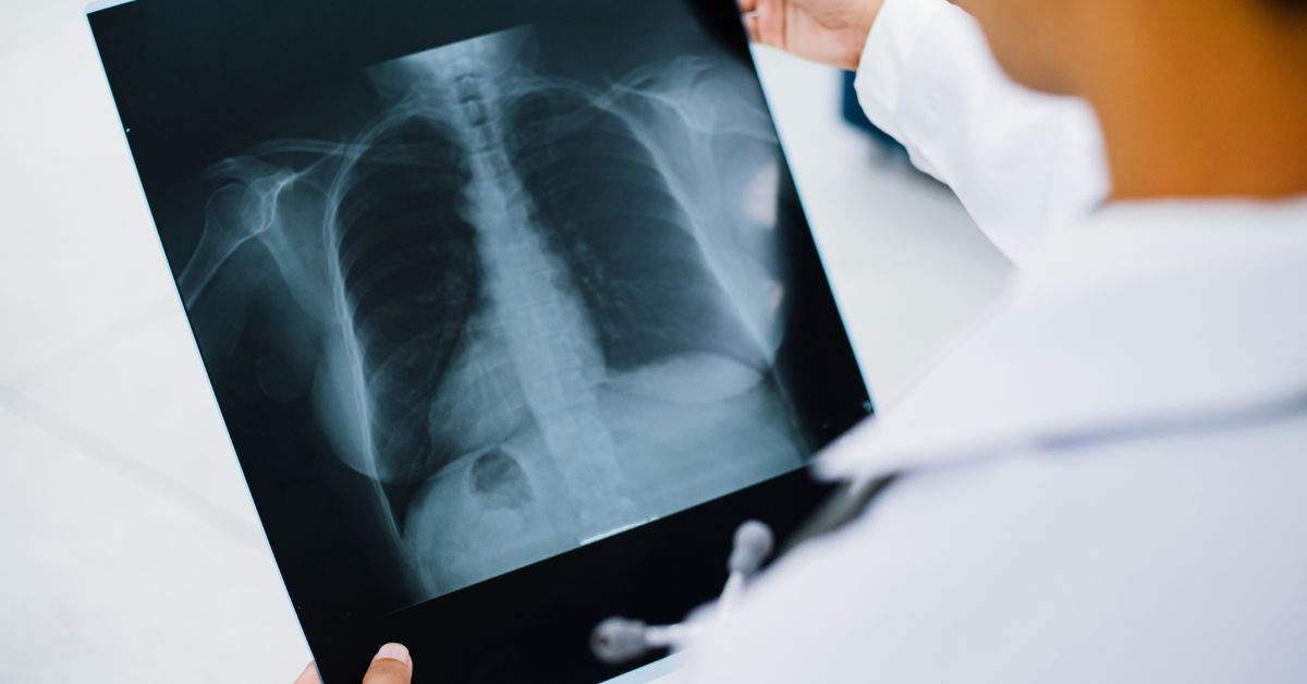 Chest Xray - DR TARUN BAID Blog