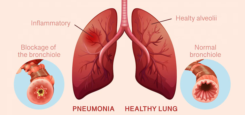 Pneumonia