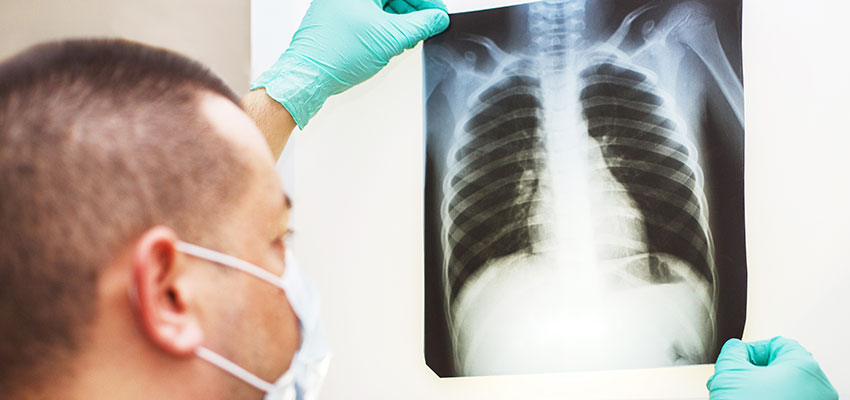 Interstitial Lung Disease