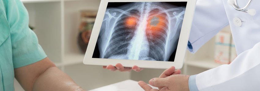 Lung Cancer Screening